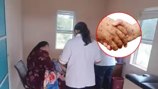 Cómo llegó el sarampión a Campeche: Esto es lo que se sabe