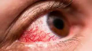 Conjuntivitis se dispara en Campeche por calor y contacto con agua contaminada