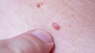 Campeche registra 56 casos de VPH en 2025; principal causa de cáncer en mujeres: síntomas y dónde vacunarse  