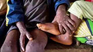 OMS declara emergencia internacional por brote de mpox en África central
