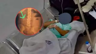 ¡Olvidan gasa en su abdomen! Paciente denuncia negligencia médica en el IMSS Playa del Carmen