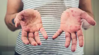 Sarampión coloca a Campeche en foco rojo epidemiológico