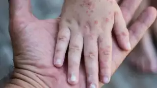 EU enfrenta peor brote de sarampión en 33 años: más de mil 200 casos y tres muertes en 2025