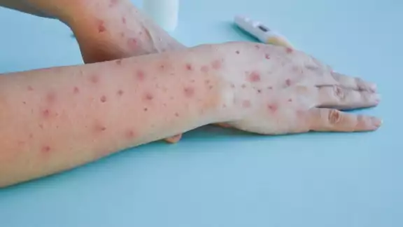 En México se registran 49 casos activos 