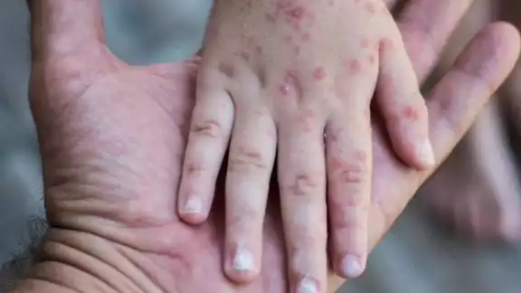 La comunidad médica ha hecho un llamado urgente a las familias para completar el esquema de vacunación infantil La comunidad médica ha hecho un llamado urgente a las familias para completar el esquema de vacunación infantil