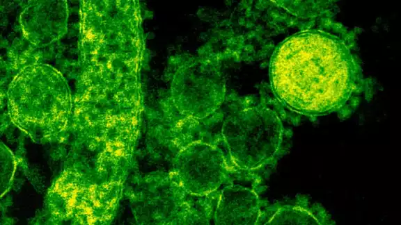 Estos son los síntomas principales de la bacteria Klebsiella Oxytoca
