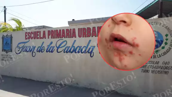 Brote del virus Coxsackie provoca alarma en la primaria Juan de la Cabada Vera, en Ciudad del Carmen. Brote del virus Coxsackie provoca alarma en la primaria Juan de la Cabada Vera, en Ciudad del Carmen.
