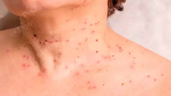 La enfermedad causa verrugas y aumenta el riesgo de ciertos tipos de cáncer La enfermedad causa verrugas y aumenta el riesgo de ciertos tipos de cáncer