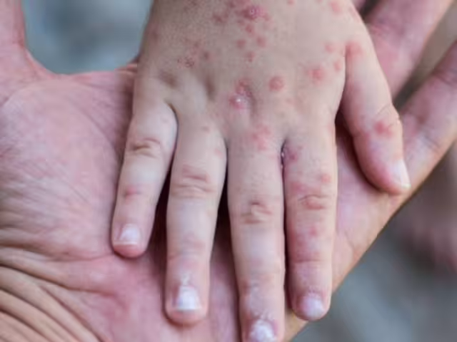 Este virus es muy contagioso, principalmente entre menores. Los adultos también lo pueden contraer.