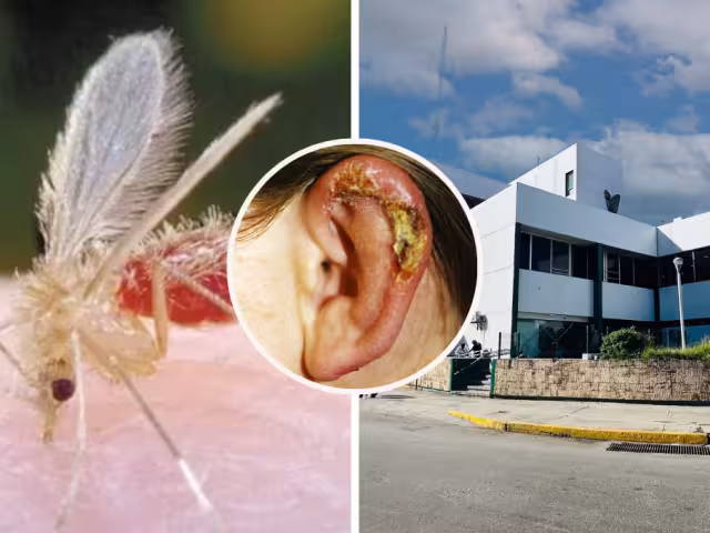 La Leishmaniasis tiene mayor incidencia en Candelaria, Calakmul y parte de Hopelchén por la vegetación; también es tratable, aunque las lesiones no cierran.