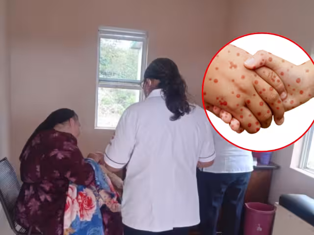 El sarampión llegó a Hopelchén tras un viaje a Chihuahua de una familia que contrajo el virus