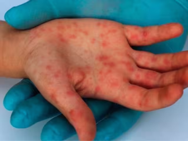 Al día de hoy, el sarampión ha provocado 12 muertes, de las cuales 11 ocurrieron en Chihuahua