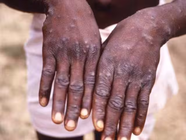 África alerta por epidemia de mpox