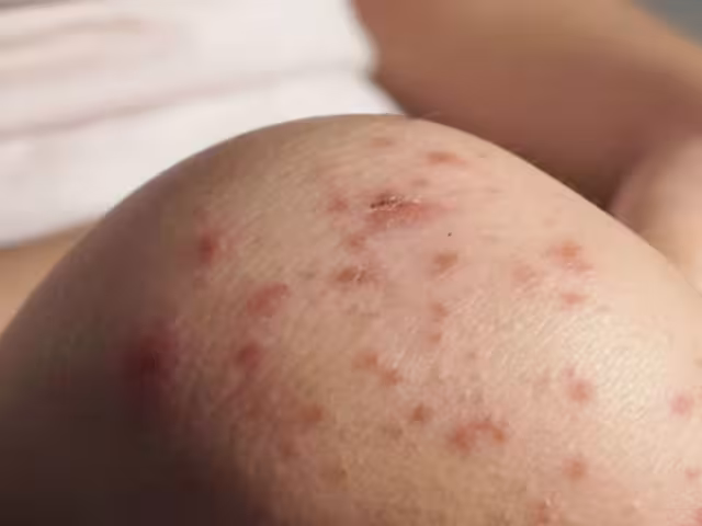 El aumento en los casos de sarampión en México, se produce en el contexto de una alerta sanitaria en Texas, Estados Unidos