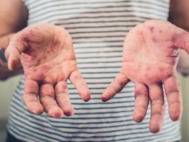 El sarampión se transmite por gotículas respiratorias y contacto cercano con personas infectadas