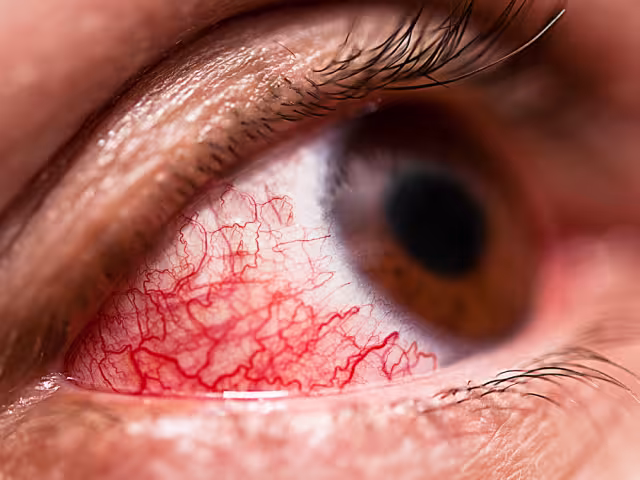 Casos de conjuntivitis aumentan en la Península debido al calor.