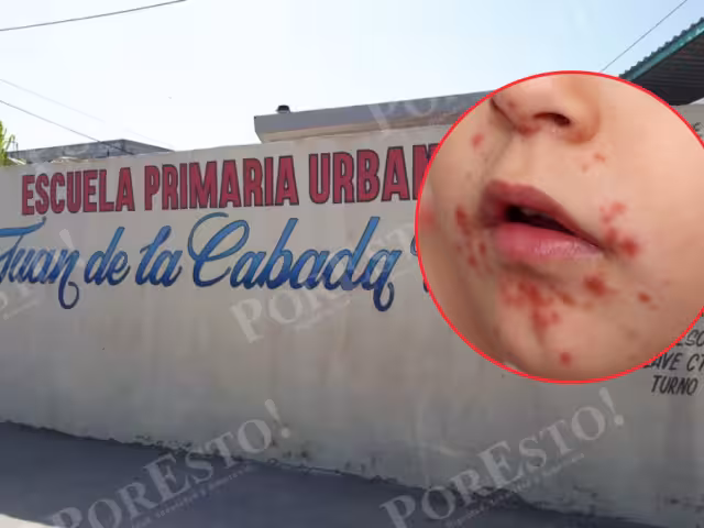 Brote del virus Coxsackie provoca alarma en la primaria Juan de la Cabada Vera, en Ciudad del Carmen.