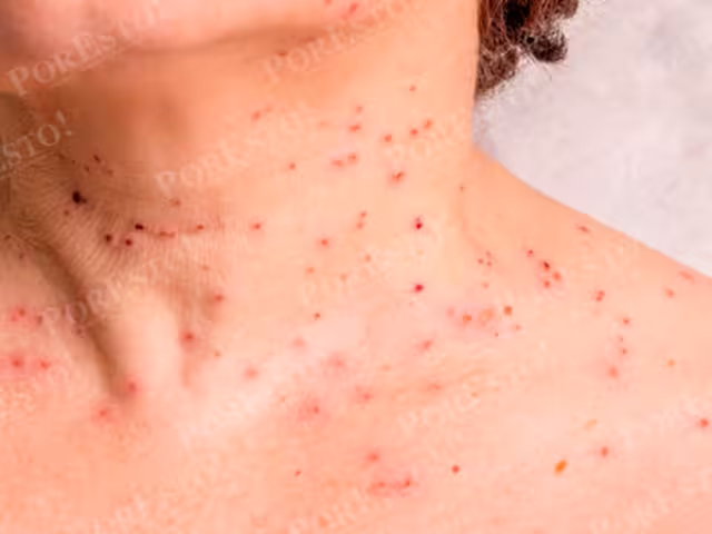 La enfermedad causa verrugas y aumenta el riesgo de ciertos tipos de cáncer