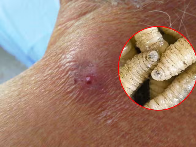 SSA confirma deceso por infección parasitaria en Campeche