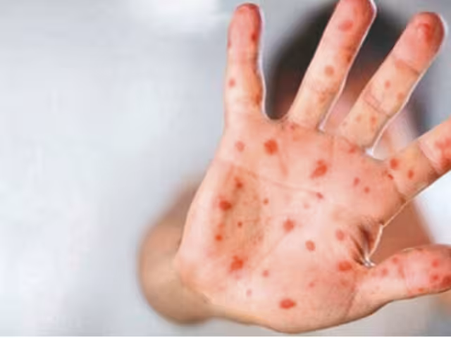 En México no se ha registrado ningún contagio de la variante más letal de mpox