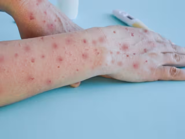 En México se registran 49 casos activos 