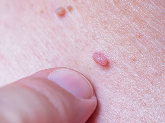 Campeche suma 56 casos de VPH en 2025, 47 en mujeres y 9 en hombres.