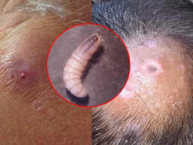 Miasis humana en Campeche: La enfermedad es causada por el gusano barrenador del ganado (Cochliomyia hominivorax).