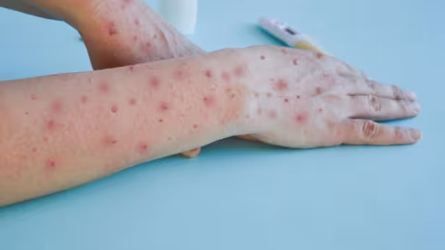 En México se registran 49 casos activos 