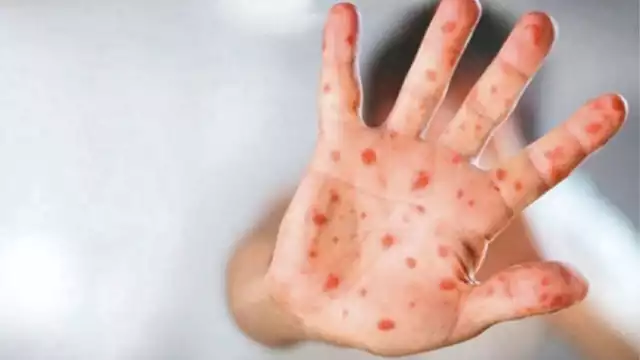 En México no se ha registrado ningún contagio de la variante más letal de mpox