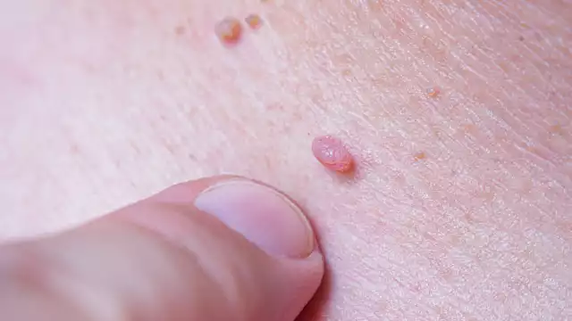 Campeche suma 56 casos de VPH en 2025, 47 en mujeres y 9 en hombres.