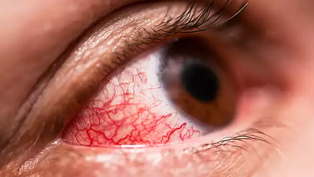 Casos de conjuntivitis aumentan en la Península debido al calor.