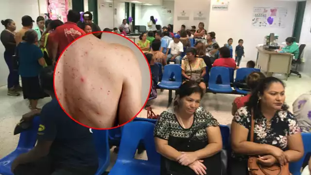 Sarampión en Campeche: Hopelchén reporta todos los casos confirmados del estado