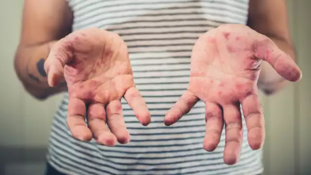 El sarampión se transmite por gotículas respiratorias y contacto cercano con personas infectadas