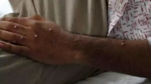 Tailandia registró el primer caso de la nueva variante de mpox