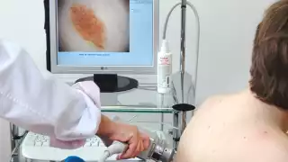 Aumentan contagios de sífilis adquirida en Quintana Roo: Más de 300 en lo que va del 2025