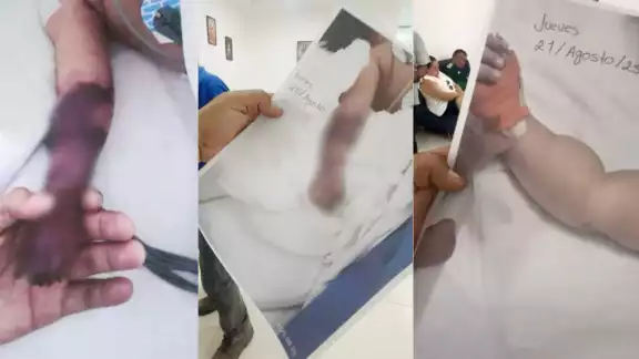 Indignación en Cancún: acusan a hospital de amputar brazo a bebé tras infección Indignación en Cancún: acusan a hospital de amputar brazo a bebé tras infección