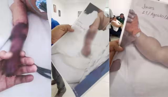 Indignación en Cancún: acusan a hospital de amputar brazo a bebé tras infección