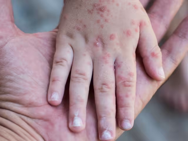 Suman 23 estudiantes enfermos por Coxsackie en dos escuelas de Calkiní