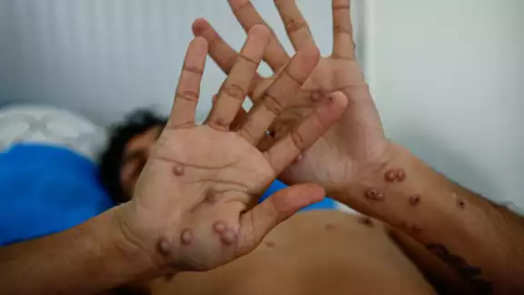 Se realizó la toma de muestras necesarias para poder establecer si es o no un caos de viruela Simica Se realizó la toma de muestras necesarias para poder establecer si es o no un caos de viruela Simica