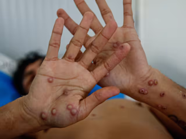 La enfermedad puede transmitirse por contacto directo con lesiones en la piel