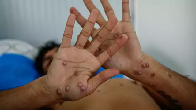 La enfermedad puede transmitirse por contacto directo con lesiones en la piel