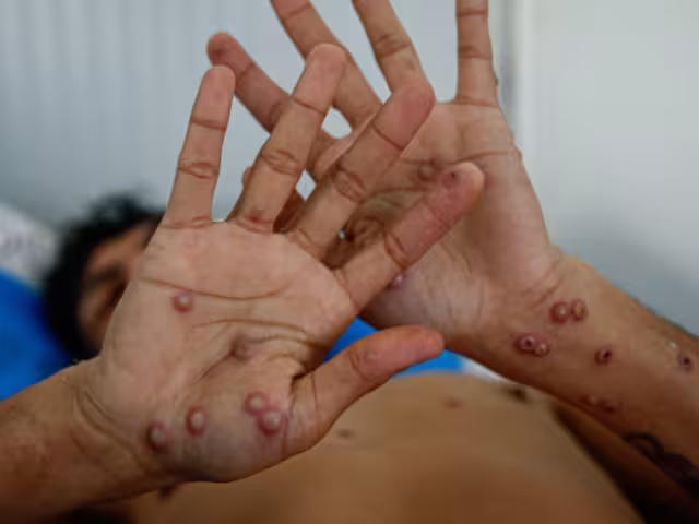Se trata del primer fallecimiento vinculado a mpox en Quintana Roo durante este año