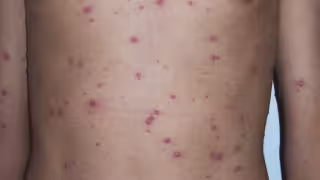 A nivel Península, Campeche ocupa el tercer lugar en casos, segundo Quintana Roo y en primero va Yucatán