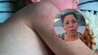 Sarampión en Campeche: Salud llama a vacunarse tras 14 contagios confirmados   