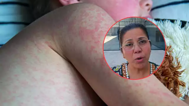 Nuevo caso de sarampión en Campeche enciende alertas; mayoría de pacientes no estaban vacunados