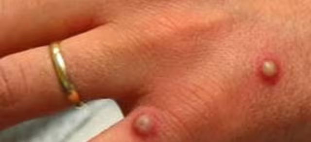 India registra primer caso de la variante más letal de mpox