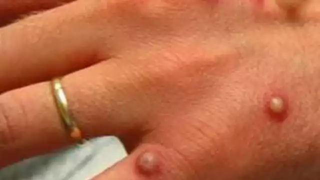 India registra primer caso de la variante más letal de mpox