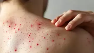 Campeche registró tres nuevos casos de sarampión, todos en el municipio de Hopelchén, sumando 12 contagios en lo que va de 2025