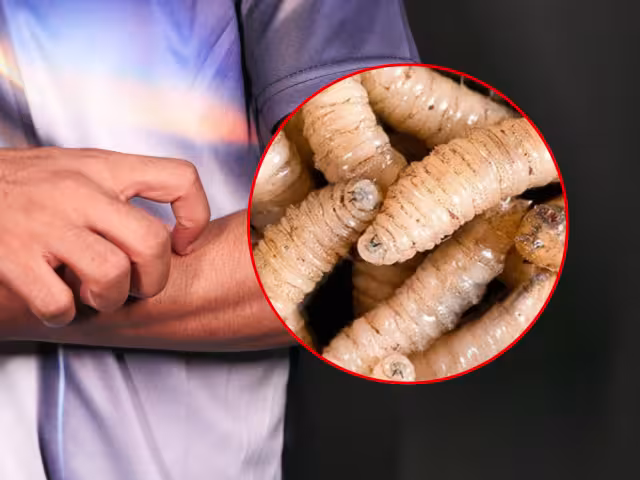 Primer caso de miasis en humano en México: Confirmado en Chiapas