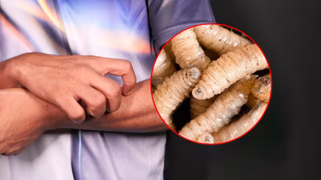 Primer caso de miasis en humano en México: Confirmado en Chiapas